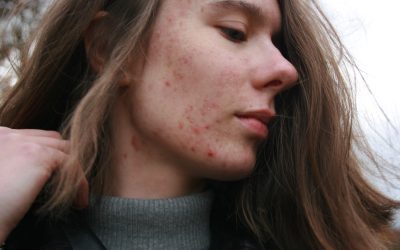 Can An Unhealthy Gut Cause Acne?